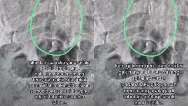 Instagram stories foto hasil rontgen tubuh Stevie Agnecya
