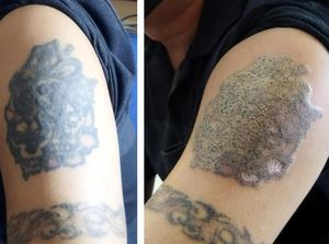 Penampakan Before-After Gambar di Lengan Fauzi Peserta Hapus Tato Gratis Penampakan Before-After Gambar di Lengan Fauzi Peserta Hapus Tato Gratis