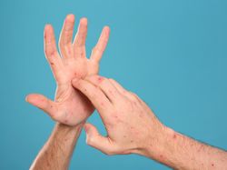 Dokter Wanti-wanti Penularan Flu Singapura yang Berpotensi Meluas saat Mudik