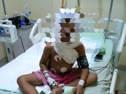 Tersambar Api Saat Bakar Sampah, Bocah di Karangasem Luka Parah