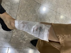 Cerita Nita Hapus Tato yang Tutupi Luka: Celekit-celekit Sakit