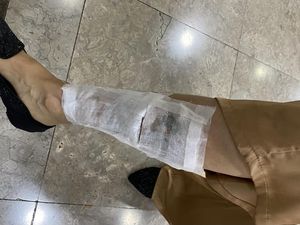 Cerita Nita Hapus Tato yang Tutupi Luka: Celekit-celekit Sakit Cerita Nita Hapus Tato yang Tutupi Luka: Celekit-celekit Sakit