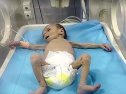 Pilu Bayi 2 Bulan di Gaza Berjuang Melawan Gizi Buruk