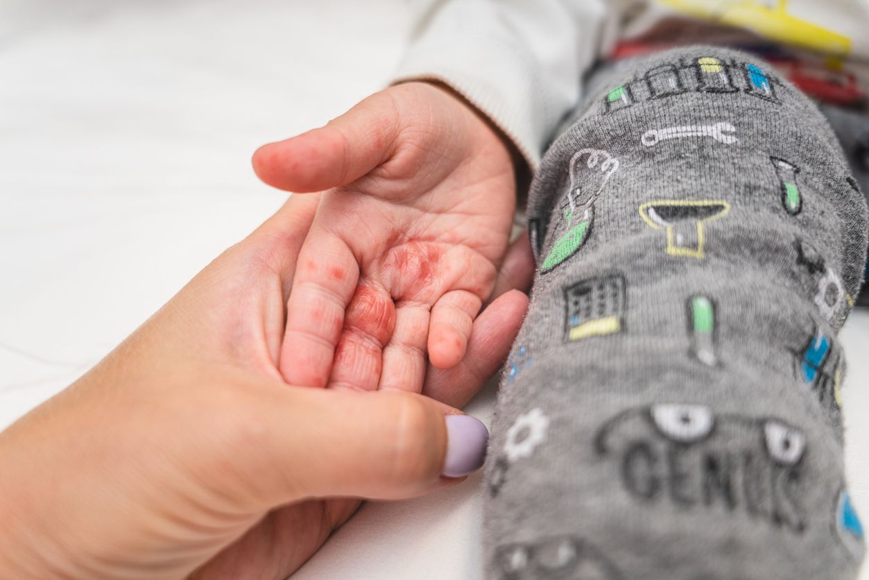 Close up enterovirus on baby body