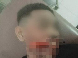 Ngeri, Pria Alor Luka Parah di Wajah gegara Dibacok OTK
