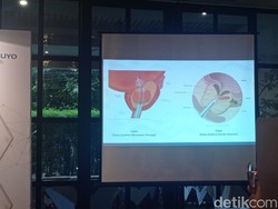 Raja Charles III Saja Bisa Kena, Kapan Sih Pria Harus Periksa Prostat?