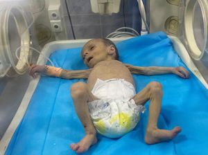 Potret Pilu Balita Palestina Berjuang Lawan Malnutrisi di Gaza