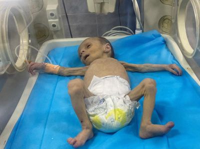 Potret Pilu Balita Palestina Berjuang Lawan Malnutrisi di Gaza