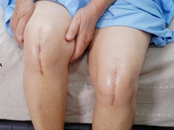 Medisata Perkenalkan Operasi Ganti Lutut dengan Bantuan Robot