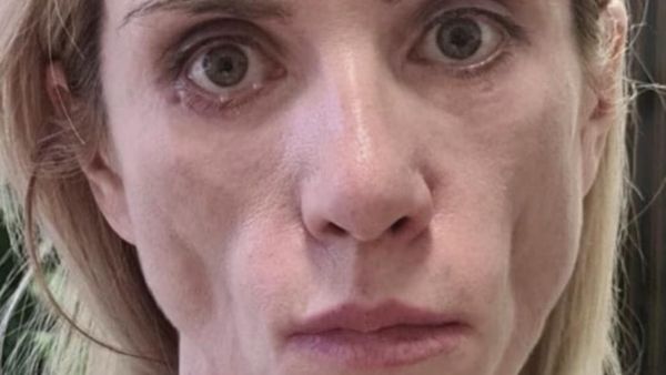 Foto Ratu Kecantikan yang Operasi Plastiknya Gagal, Tak Bisa Tutup Mata