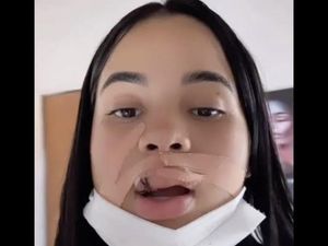 Influencer Ini Bibirnya Digigit Anjing Peliharannnya, Berakhir 10 Jahitan