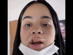 Influencer Ini Bibirnya Digigit Anjing Peliharannnya, Berakhir 10 Jahitan