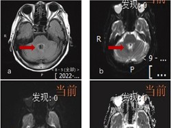 Ngeri! Nenek Ini Tewas Usai Terinfeksi Amoeba Pemakan Otak