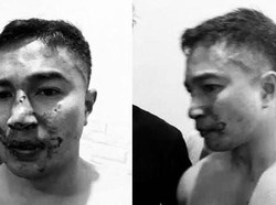 Penampakan Wajah Nakes Babak Belur Diduga Dianiaya Oknum Polisi di Gorontalo