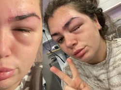 Usai Sulam Alis, Mata Kiri Danielle Tak Bisa Melihat hingga Terancam Buta