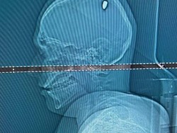 Kisah Pria Tetap Asyik Pesta Meski Peluru Bersarang di Kepala