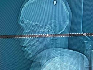 Kisah Pria Tetap Asyik Pesta Meski Peluru Bersarang di Kepala Kisah Pria Tetap Asyik Pesta Meski Peluru Bersarang di Kepala