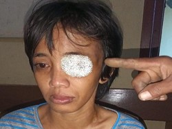 Wajah-Mata IRT di Lubuklinggau Bonyok Dihajar Suami, Pelaku Ditangkap