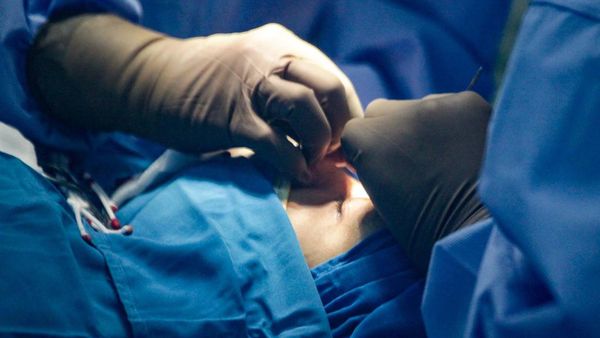 Operasi Gratis Tangani Kelainan Kelopak Mata