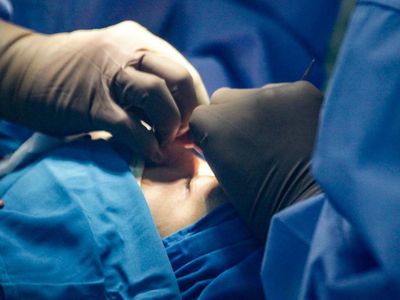 Operasi Gratis Tangani Kelainan Kelopak Mata