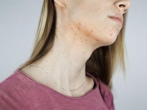 Penyebab Jerawat di Leher dan Cara Cepat Mengatasinya