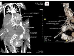 Kembar Siam Laba-laba Lahir di Jabar, Punya 3 Kaki dan 4 Tangan