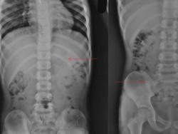 Horor, Penampakan X-Ray Bocah Telan Pensil yang Nyangkut di Perutnya