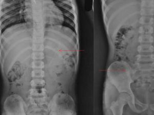 Horor, Penampakan X-Ray Bocah Telan Pensil yang Nyangkut di Perutnya Horor, Penampakan X-Ray Bocah Telan Pensil yang Nyangkut di Perutnya
