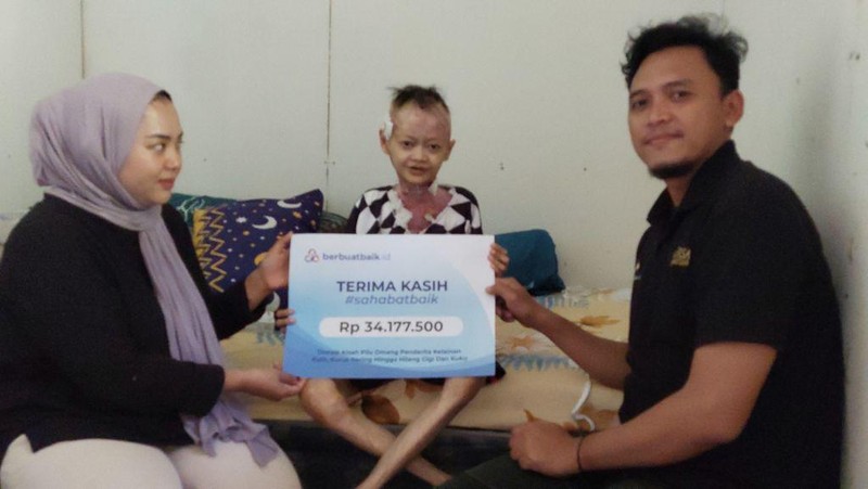 Berkat Bantuan Donasi, Kondisi Omang Penderita Kelainan Langka Membaik