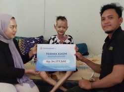 Berkat Bantuan Donasi, Kondisi Omang Penderita Kelainan Langka Membaik