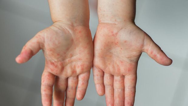 Enterovirus Legs hands mouth Rash on the body of a child Cocksackie virus