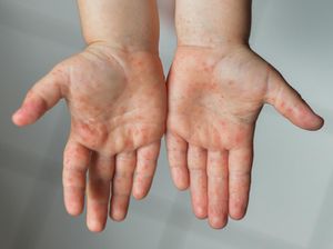 Beda Ruam Akibat Flu Singapura VS Cacar Air, Begini Membedakannya Beda Ruam Akibat Flu Singapura VS Cacar Air, Begini Membedakannya