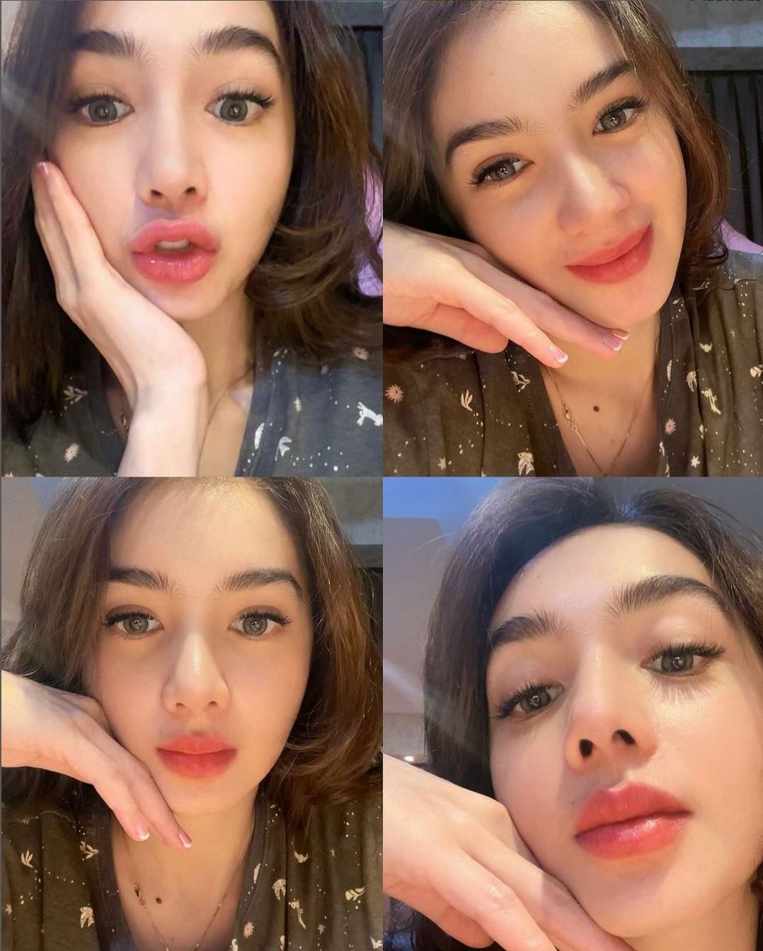 Wajah Angel Karamoy dua bulan setelah operasi plastik.