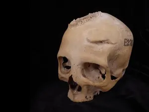 Pengobatan Kanker Zaman Kuno Terungkap Lewat Tengkorak Berusia 4.000 Tahun Pengobatan Kanker Zaman Kuno Terungkap Lewat Tengkorak Berusia 4.000 Tahun