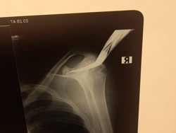 Ngeri, Bahu Ojol Masih Tertancap Celurit Saat Lari RS