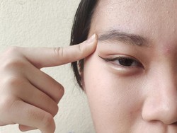 Kenapa Jerawat di Alis Sakit? Ini Penyebab dan Cara Mengobatinya