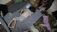 Potret Pilu Anak-anak Palestina Menderita Malnutrisi Akut