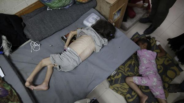 Potret Pilu Anak-anak Palestina Menderita Malnutrisi Akut