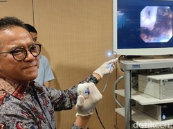 Metode RIRS untuk Pengobatan Batu Ginjal, Minim Invasif-Pasien Cepat Pulih