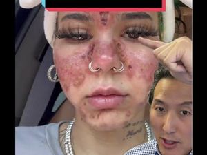 Bahaya Pakai Skincare Kedaluwarsa, Wajah Wanita Ini Jadi Terbakar