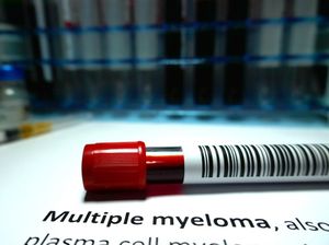 Sering Disangka Saraf Kejepit, Waspadai Gejala Kanker Multiple Myeloma Sering Disangka Saraf Kejepit, Waspadai Gejala Kanker Multiple Myeloma