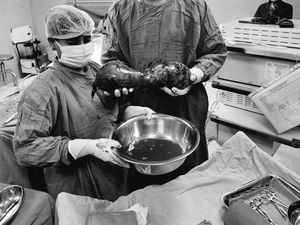 Awal Mula Pria 30-an Idap Tumor Testis Raksasa 40 Cm, Begini Kondisinya Awal Mula Pria 30-an Idap Tumor Testis Raksasa 40 Cm, Begini Kondisinya