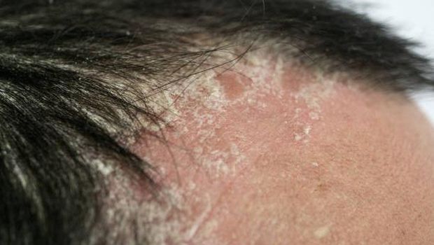 Psoriasis menjadi penyakit imun yang membuat minder penderitanya (Foto/iStock Photo)