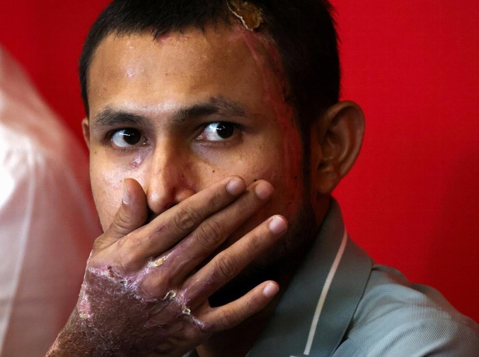 SENSITIVE MATERIAL. THIS IMAGE MAY OFFEND OR DISTURB Faisal Halim, a Malaysian footballer who was critically injured after being splashed with acid last month, reacts as he speaks to media members during a news conference at Shah Alam, Malaysia June 13, 2024. REUTERS/Hasnoor Hussain