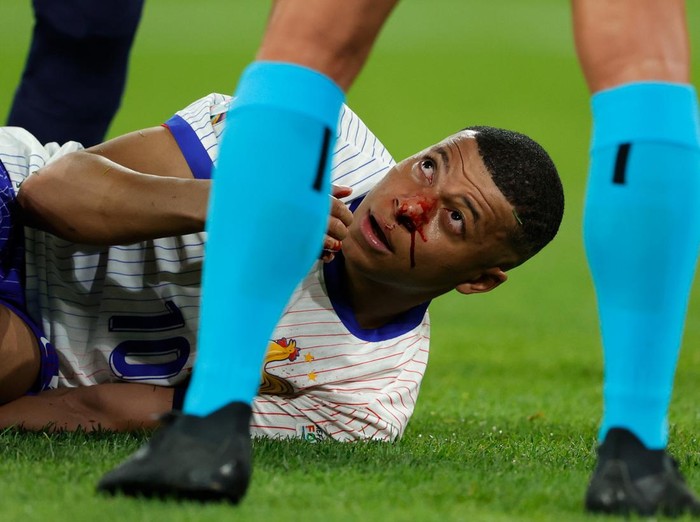 DUSSELDORF, GERMANY - JUNE 17: Kylian Mbappe of France Injured his head during the  EURO match between Austria  v France at the Merkur Spiel Arena on June 17, 2024 in Dusseldorf Germany (Photo by Rico Brouwer/Soccrates/Getty Images)