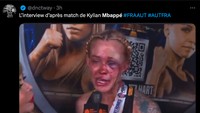 Begini situasi Mbappe saat diwawancara usai laga, babak belur. (Foto: Twitter @dnctway)