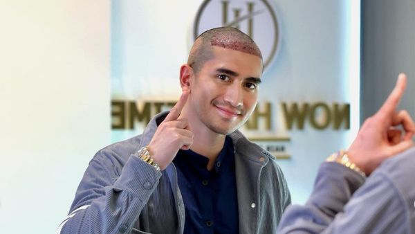 Foto Verrel Bramasta Kini Botak Demi Tanam Rambut, Kompak Bareng Adik & Ayah