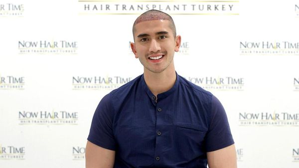 5 Potret Verrell Bramasta Usai Transplantasi Rambut di Turki