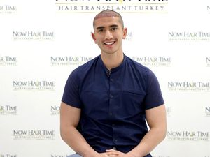 5 Potret Verrell Bramasta Usai Transplantasi Rambut di Turki