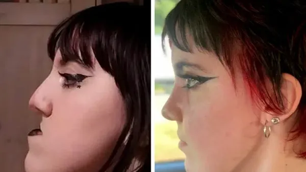 Foto Sebelum dan Sesudah Operasi Plastik Bikin Tercengang